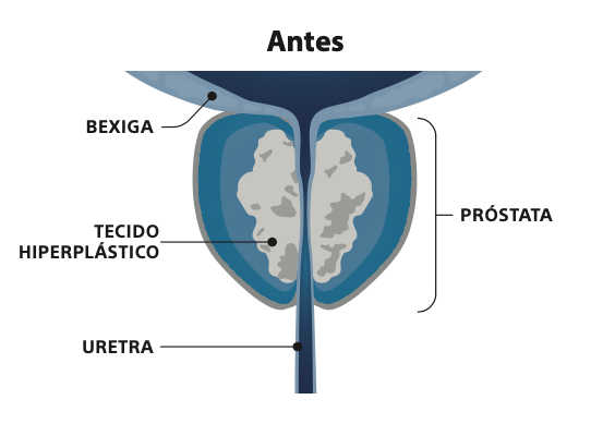 Antes-Rezum