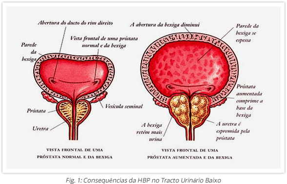 Hiperplasia-Benigna-da-Prostata-1