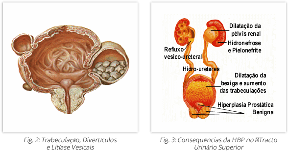 Hiperplasia-Benigna-da-Prostata-2