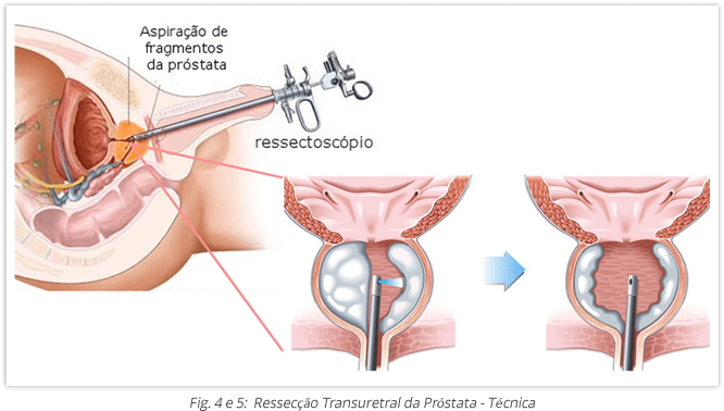 Hiperplasia-Benigna-da-Prostata-3