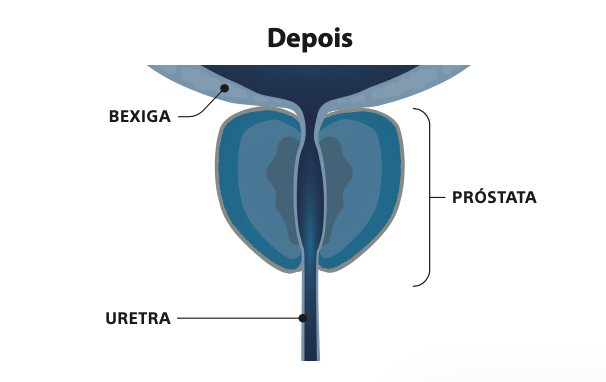 Rezum-Vapor-de-agua-tratamento-a-hiperplasia-benigna-da-próstata