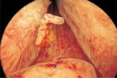 Uretrocistoscopia-flexivel-nuno-tomada