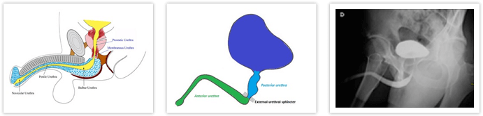 Uretroplastia-com-Enxerto-de-Mucosa-Oral-1