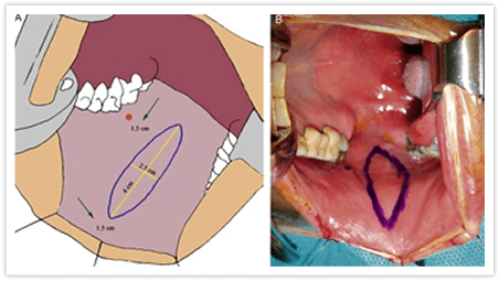 Uretroplastia-com-Enxerto-de-Mucosa-Oral-2