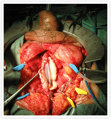 Uretroplastia-com-Enxerto-de-Mucosa-Oral-3