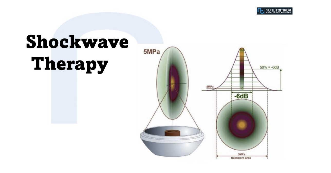 Low Intensity Shockwaves Nuno Tomada Urologist and Andrologist